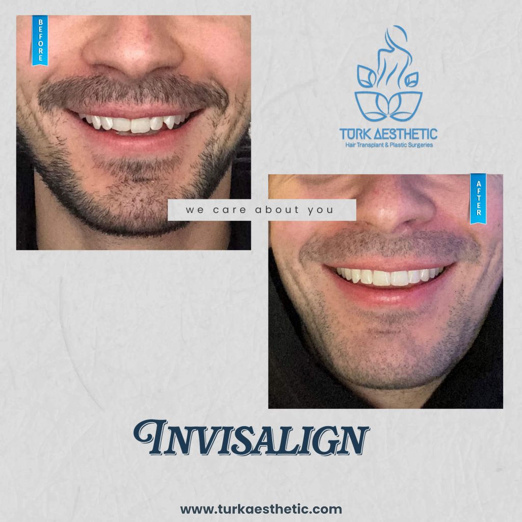 Antes y después de Invisalign en Turquía