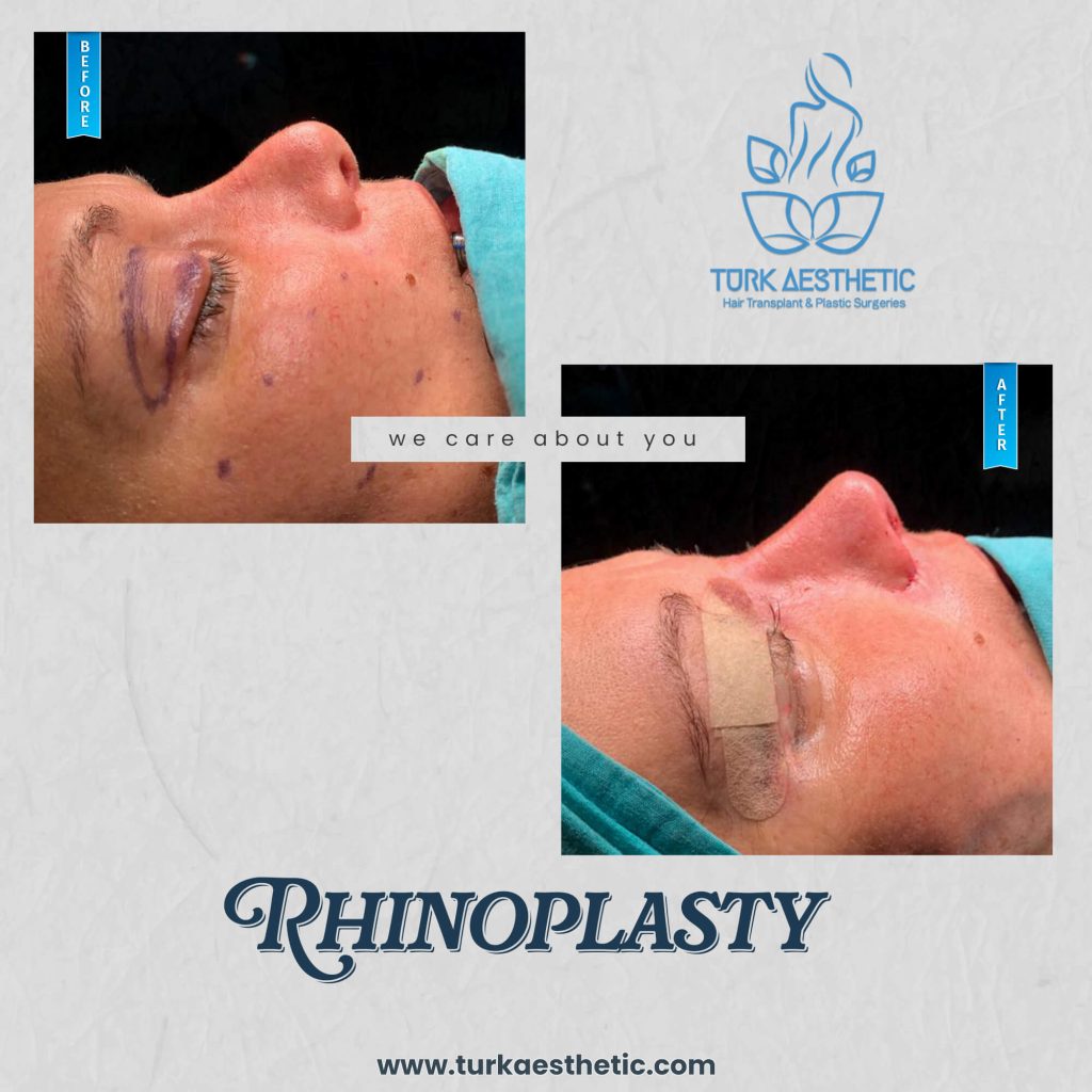 Antes y después de la rinoplastia en Türkiye