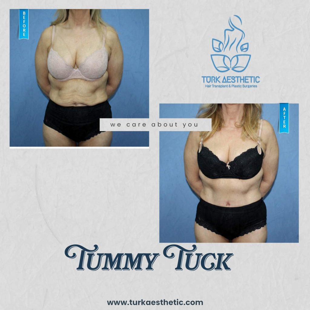 Antes y después de la abdominoplastia en Türkiye