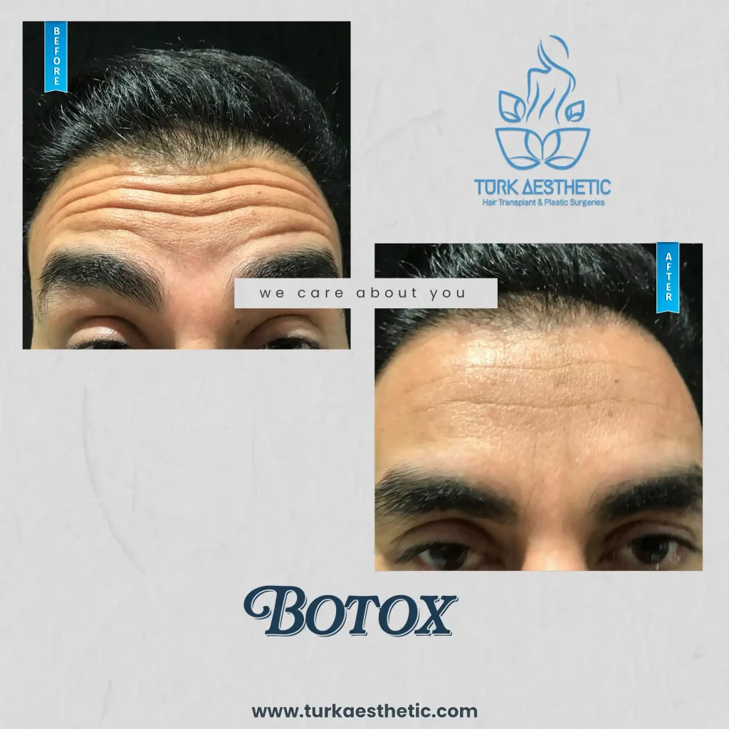 avant après le botox en Turquie