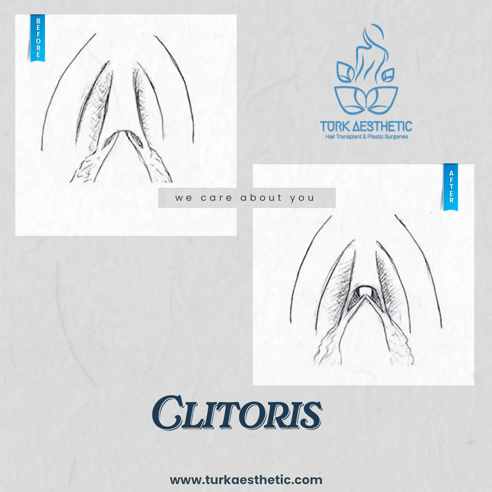 Türkiye de klitoris estetiği öncesi ve sonrası