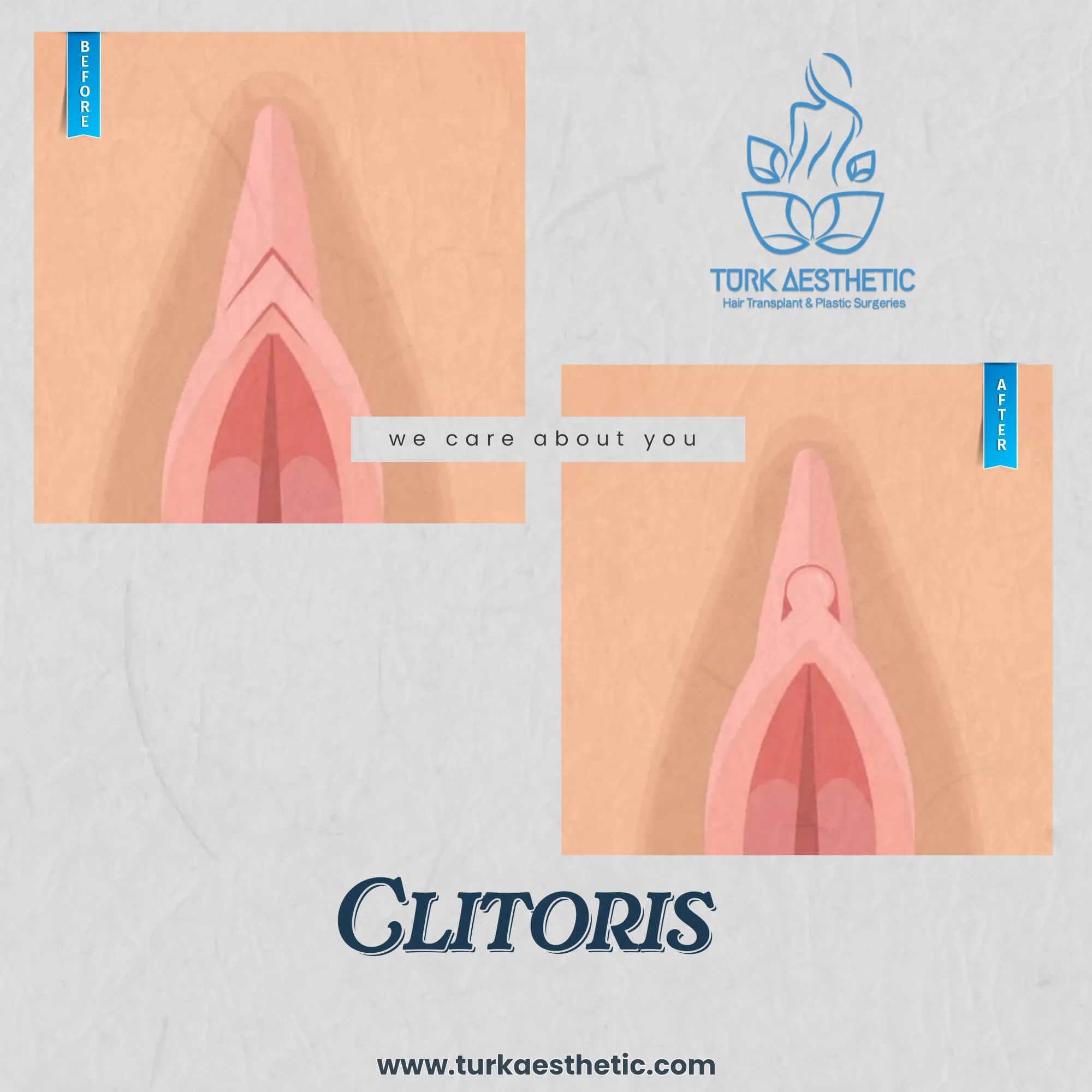 Türkiye de klitoris estetiği öncesi ve sonrası