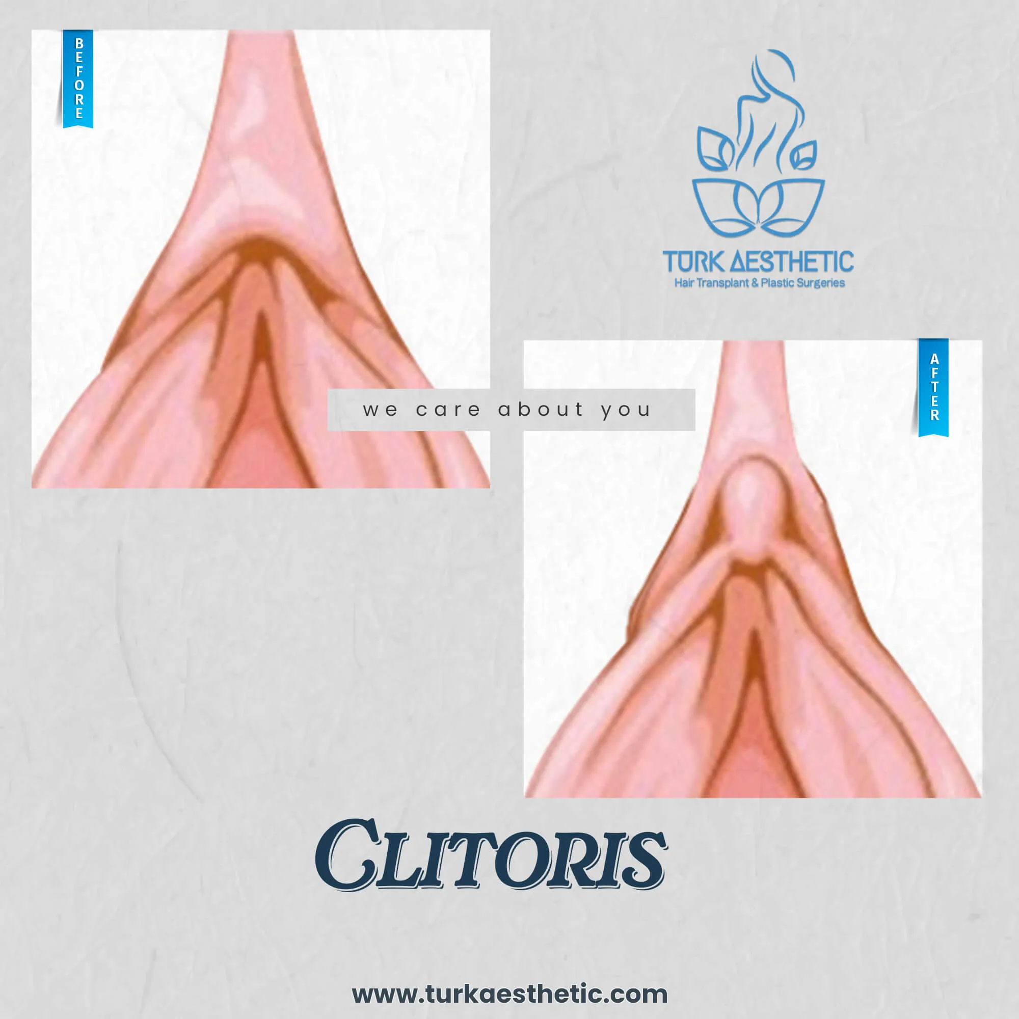 Türkiye de klitoris estetiği öncesi ve sonrası