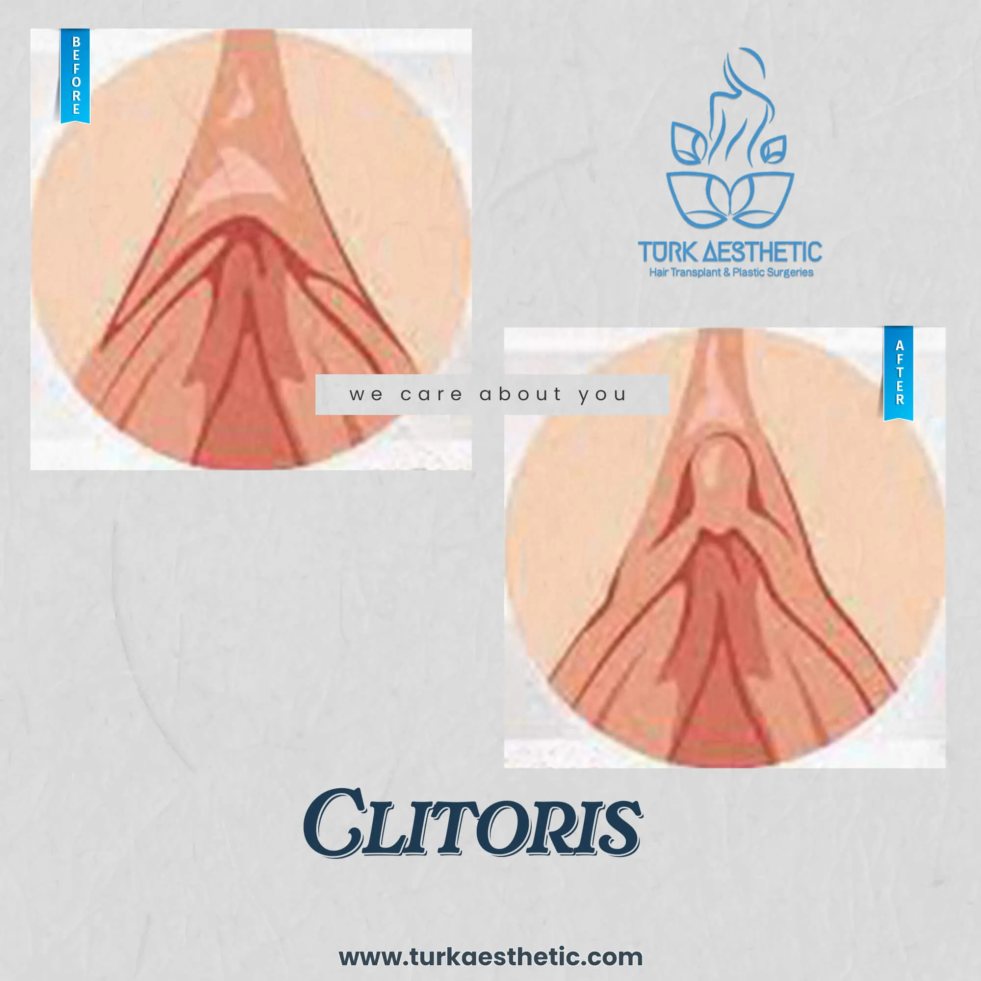 Türkiye de klitoris estetiği öncesi ve sonrası