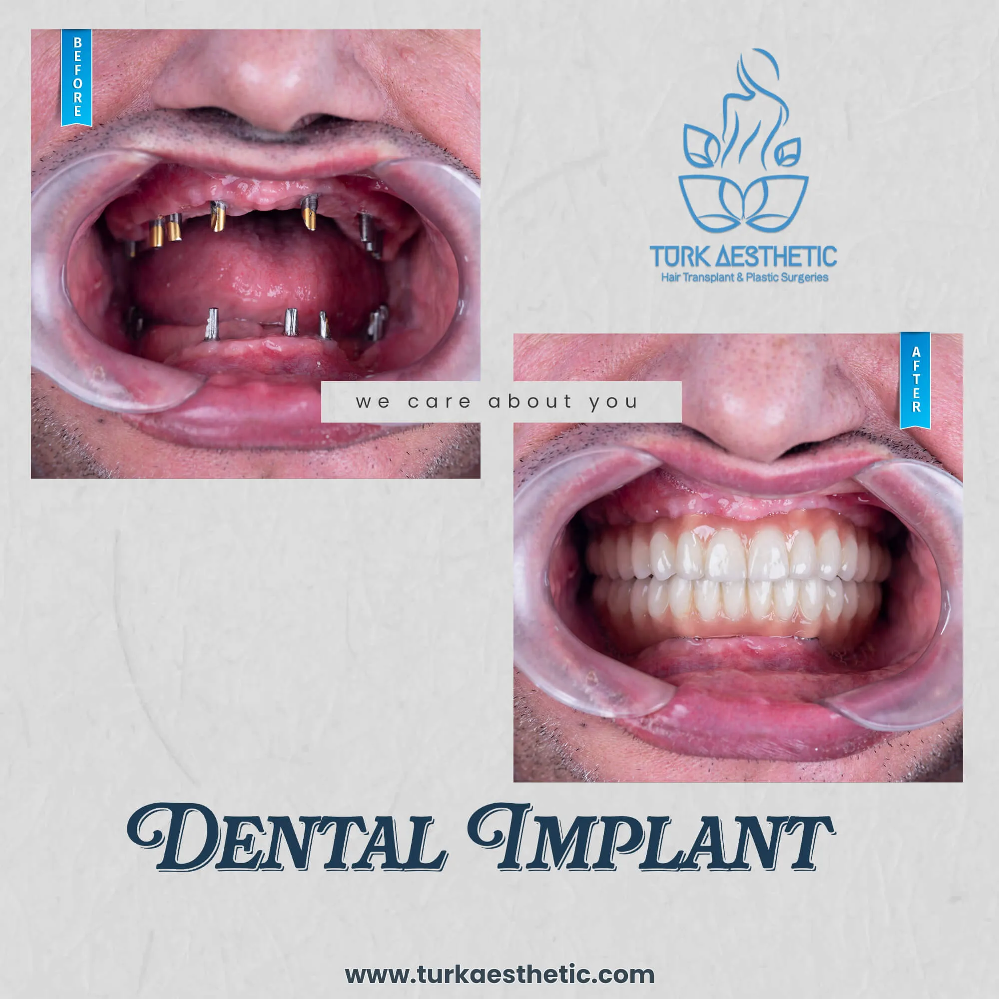 Türkiye de implant öncesi ve sonrası