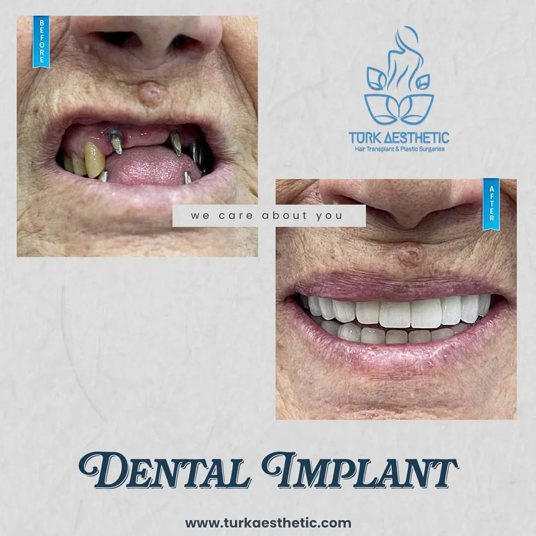 Türkiye de implant öncesi ve sonrası