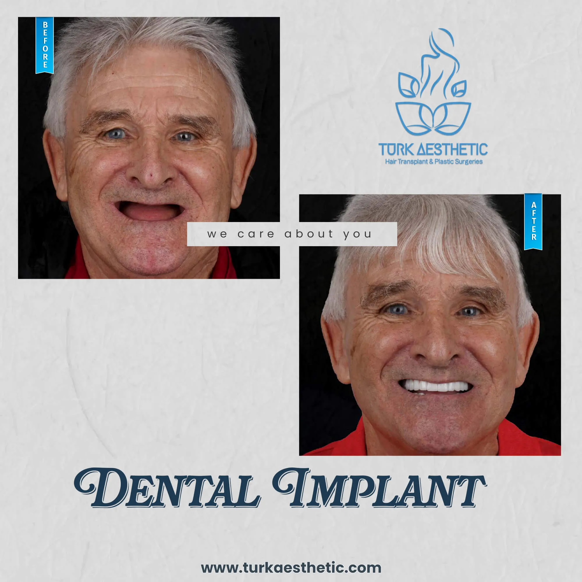 Türkiye de implant öncesi ve sonrası