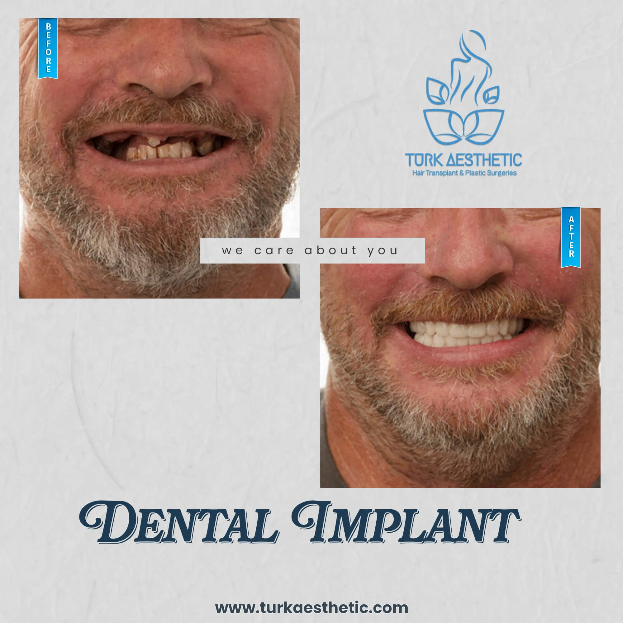 Türkiye de implant öncesi ve sonrası