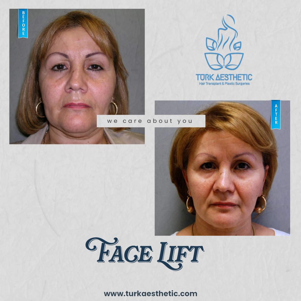 Vor und nach dem Facelift in Türkiye