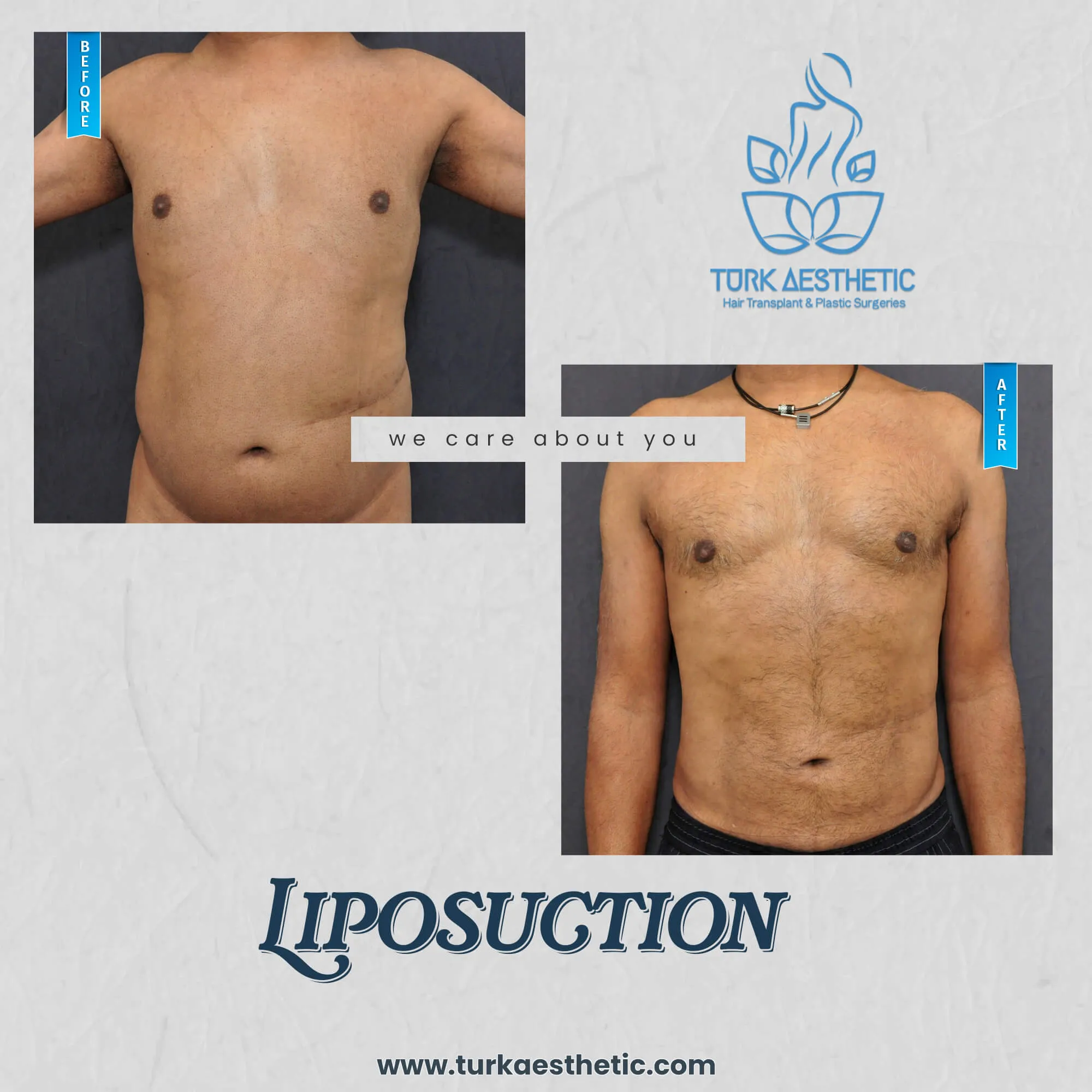 Türkiye de liposuction öncesi ve sonrası