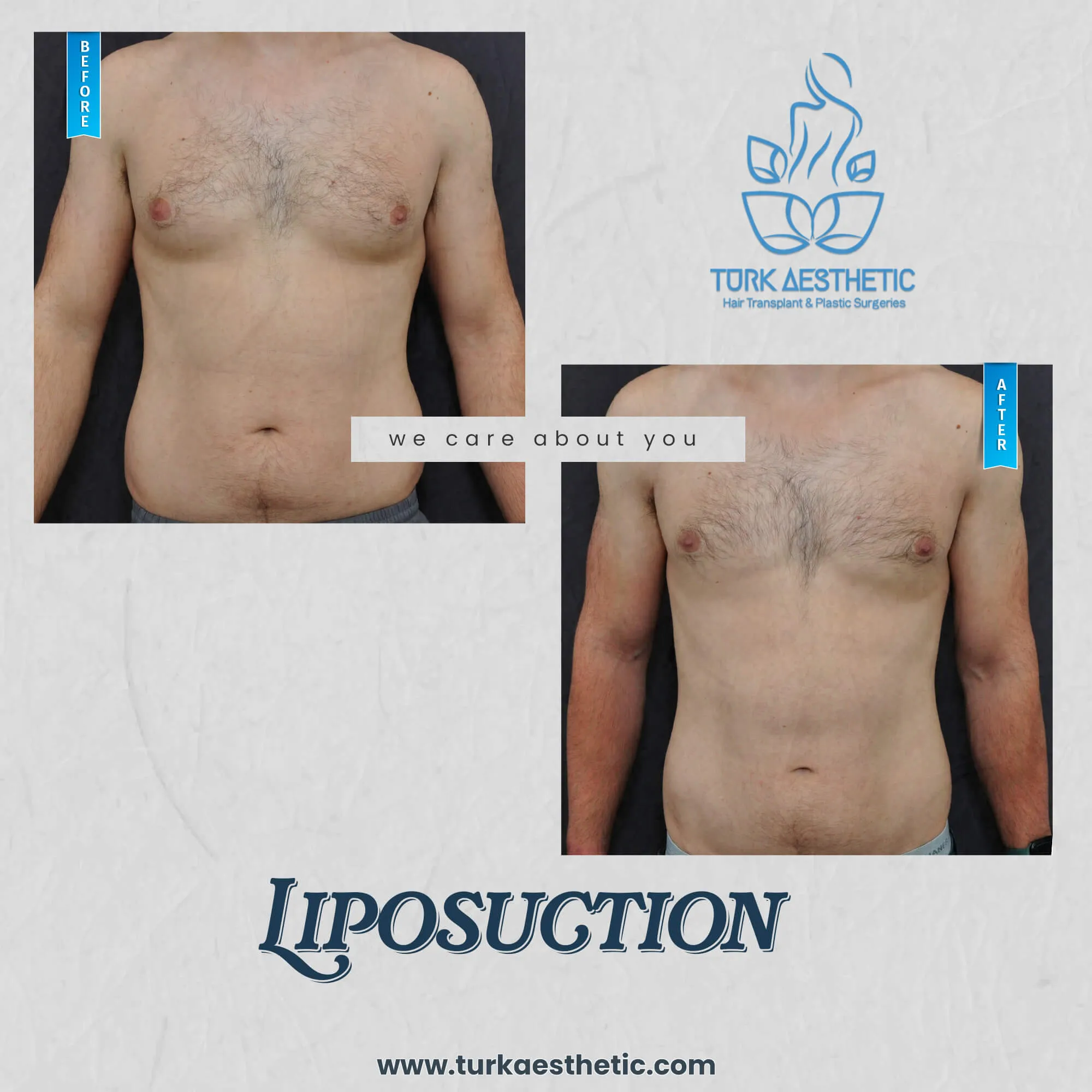 Türkiye de liposuction öncesi ve sonrası