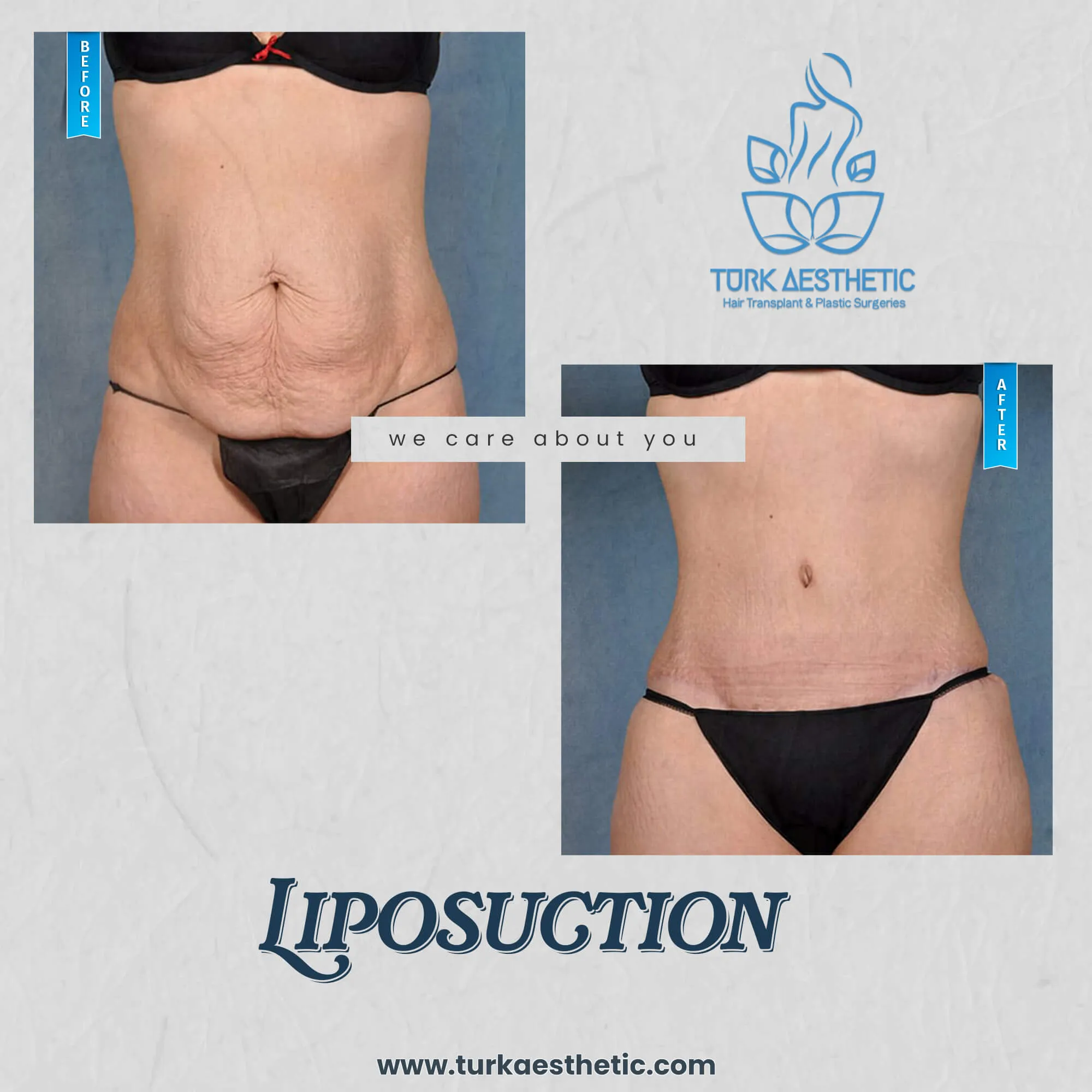 Türkiye de liposuction öncesi ve sonrası