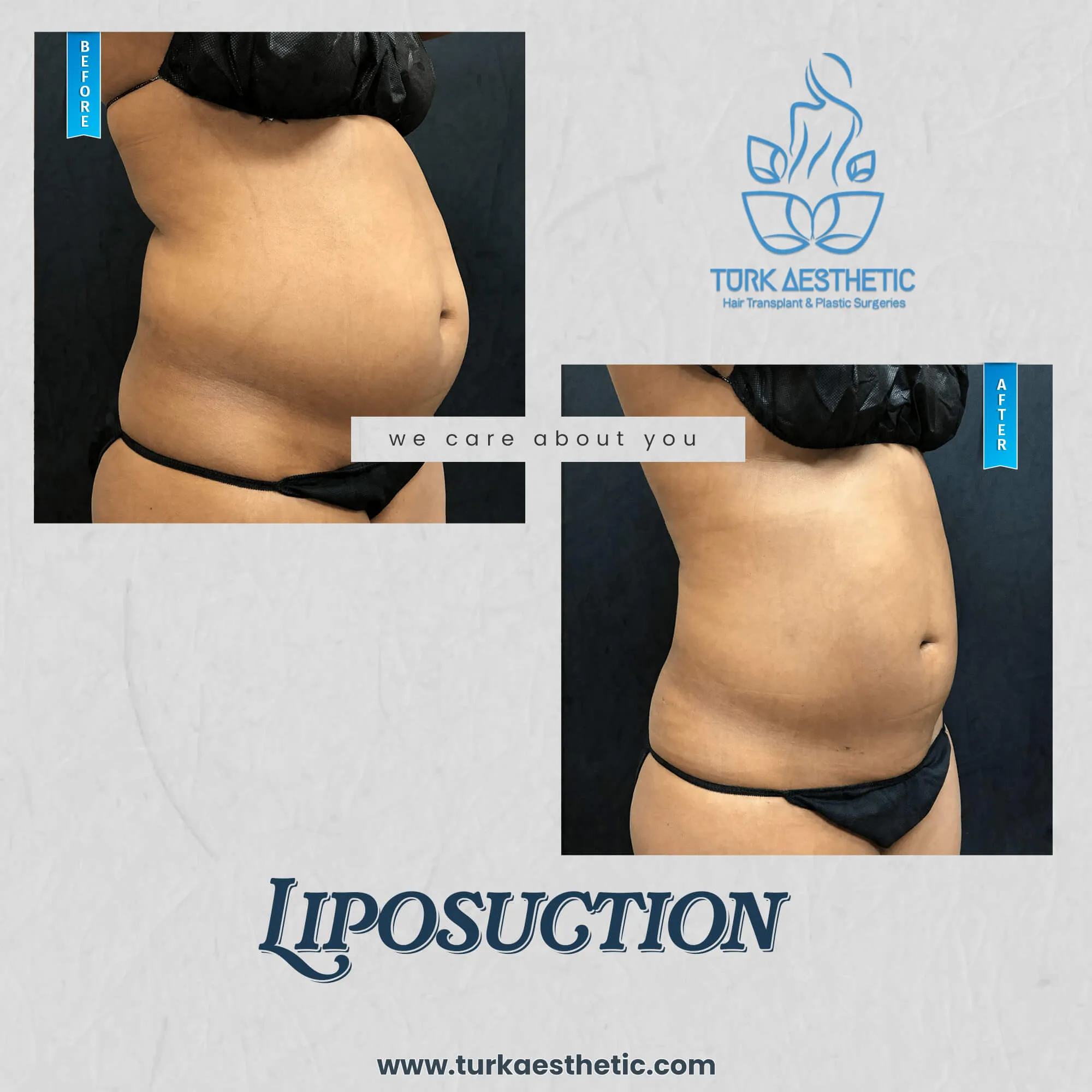 Türkiye de liposuction öncesi ve sonrası