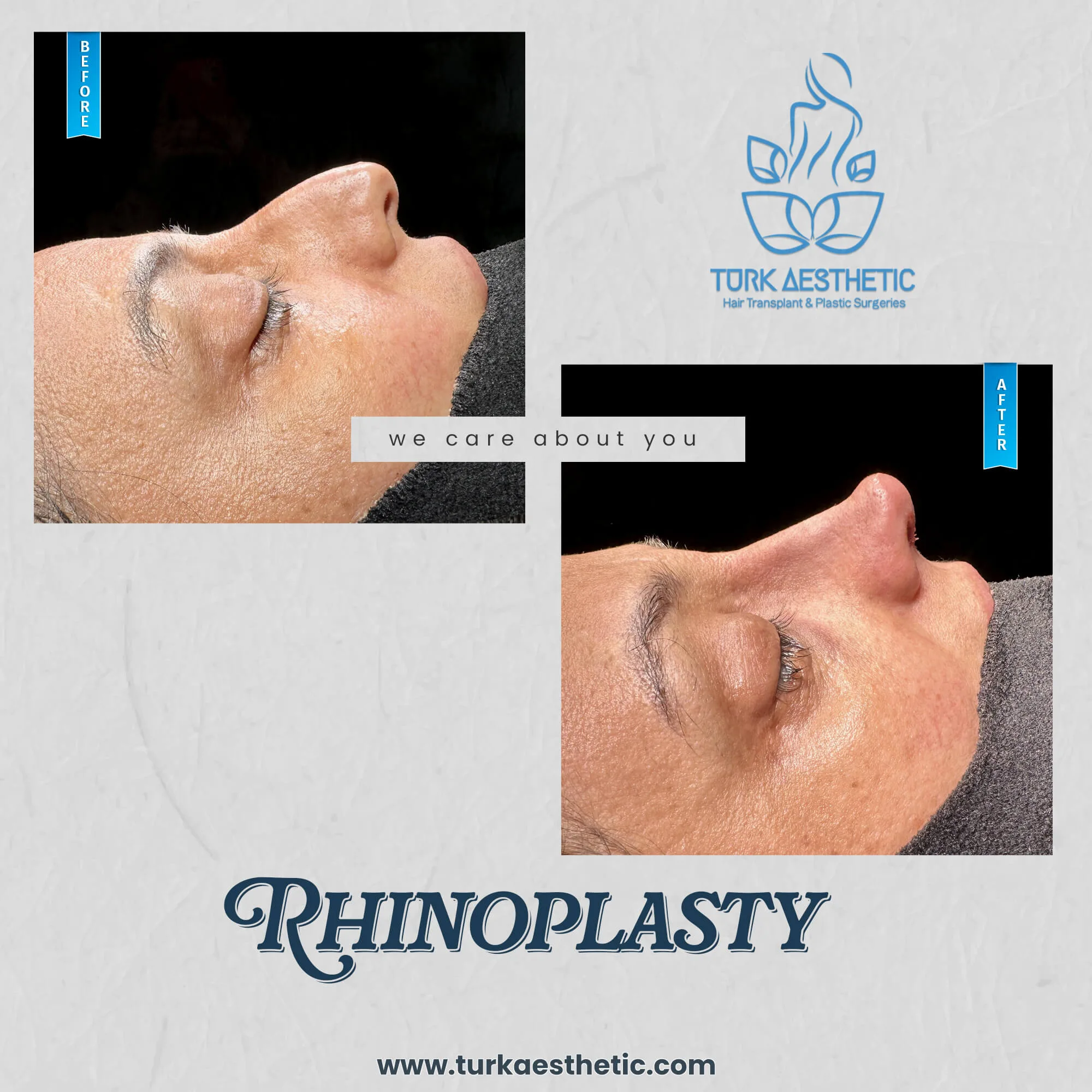 Türkiye de burun estetiği öncesi ve sonrası