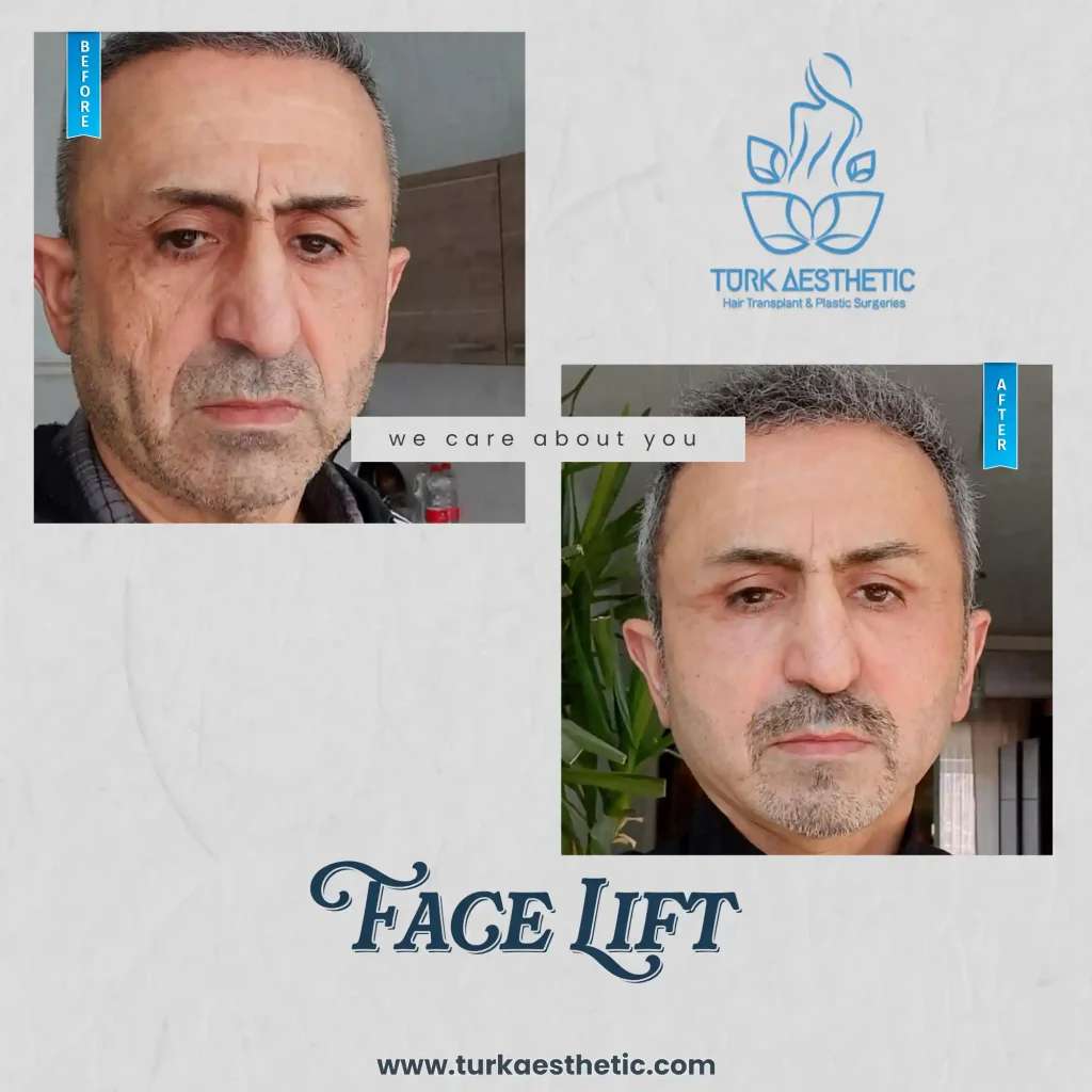 Vor und nach dem Facelift in Türkiye