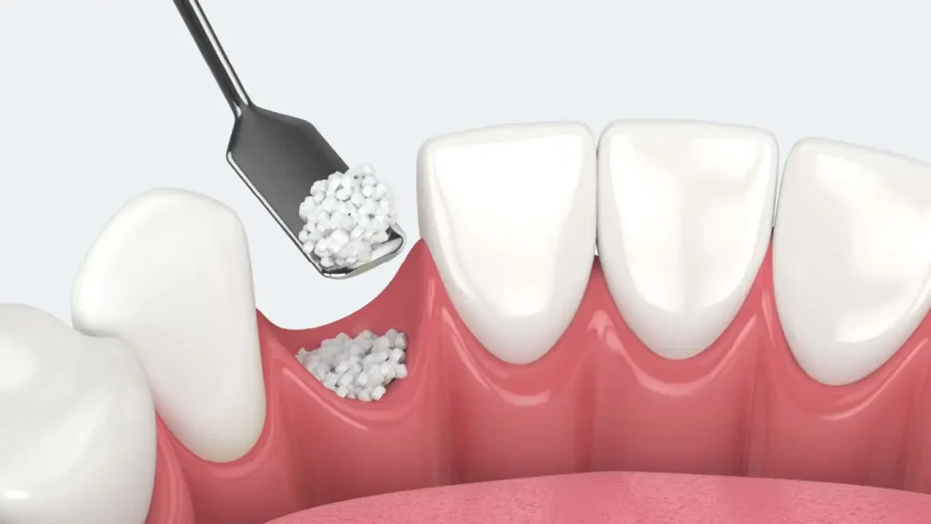 Dental Bone Graft in Turkey