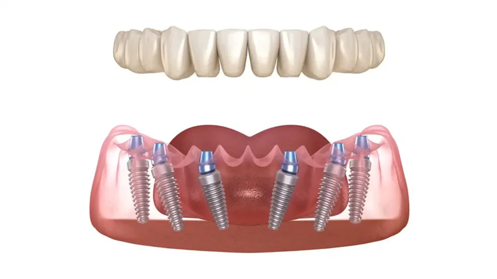 Implant dentaire All On 6 en Turquie