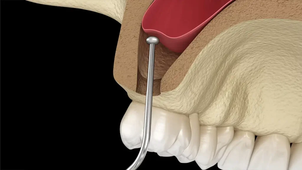 Lifting Des Sinus En Turquie